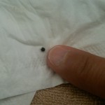 KIDNEY STONE SEEN AROUND THE WORLD