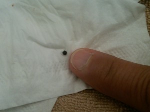 KIDNEY STONE SEEN AROUND THE WORLD